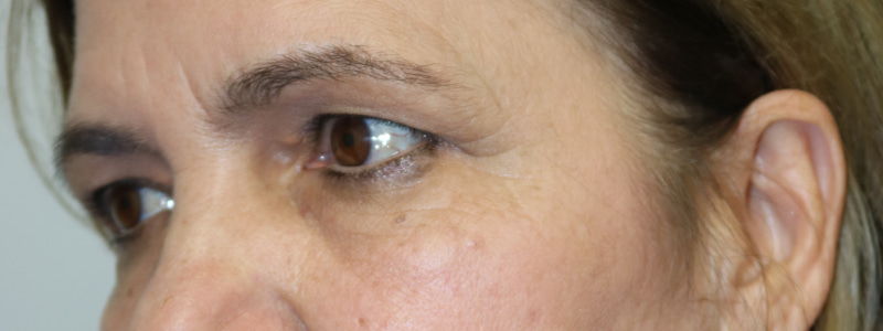 Brow Lift Before & After