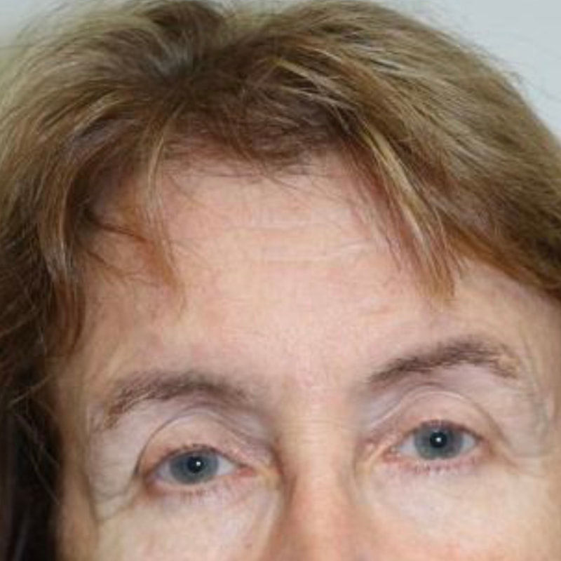 Brow Lift Before & After