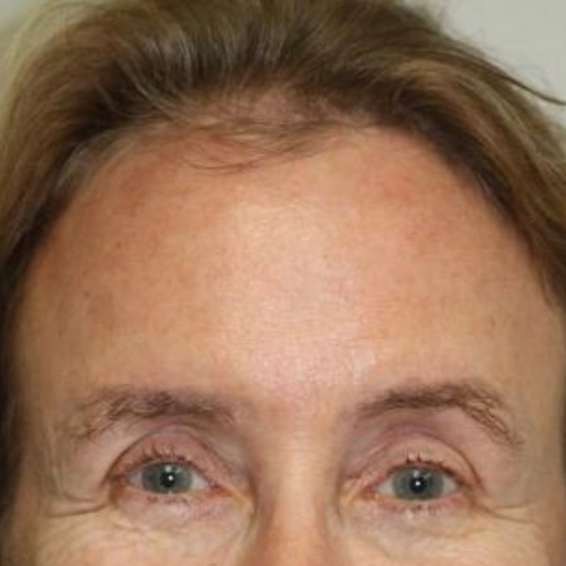 Brow Lift Before & After