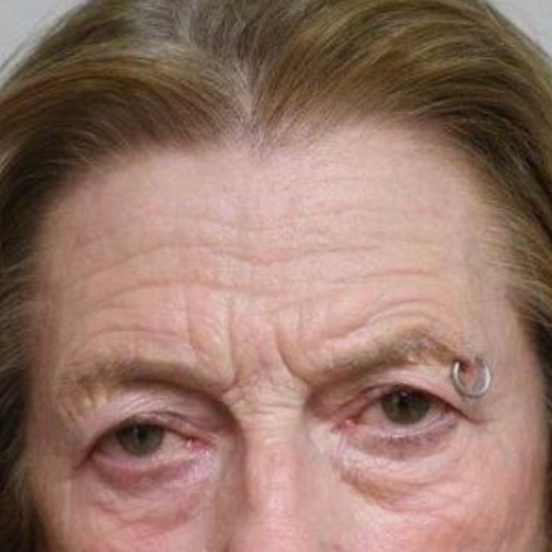 Brow Lift Before & After