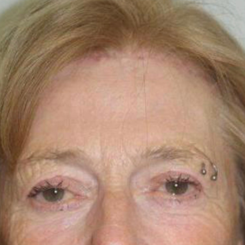 Brow Lift Before & After