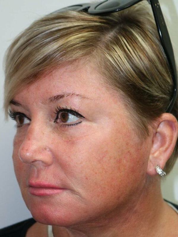 Facelift Before & After Image