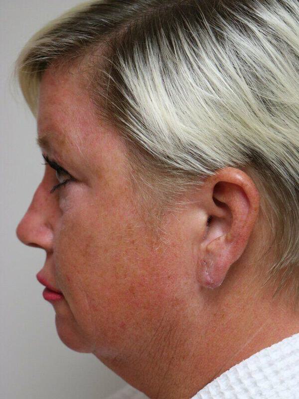 Facelift Before & After Image