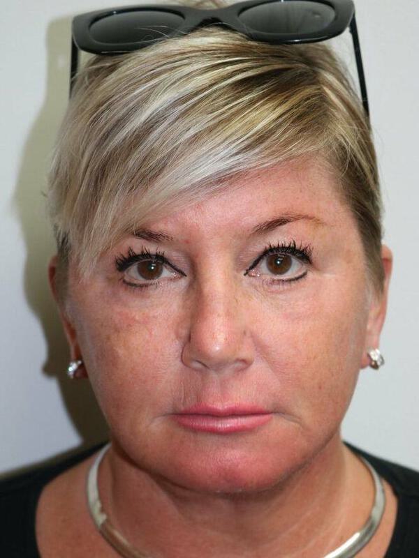 Facelift Before & After Image