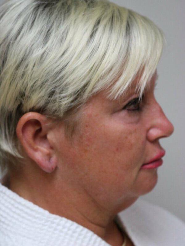 Facelift Before & After Image