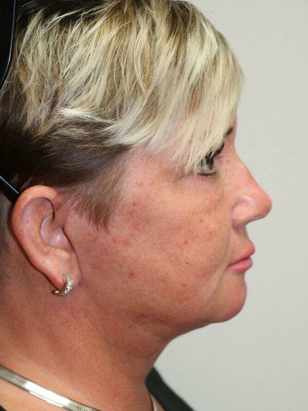 Facelift Before & After Image