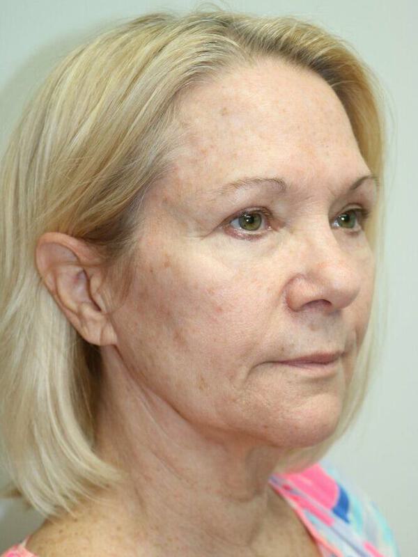 Facelift Before & After Image