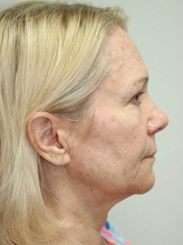 Facelift Before & After Image