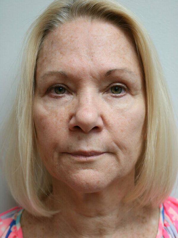 Facelift Before & After Image