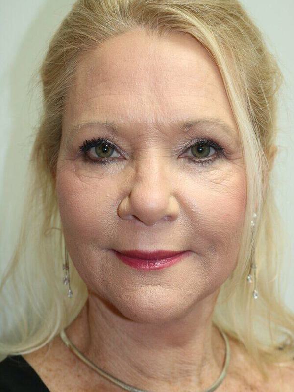 Facelift Before & After Image