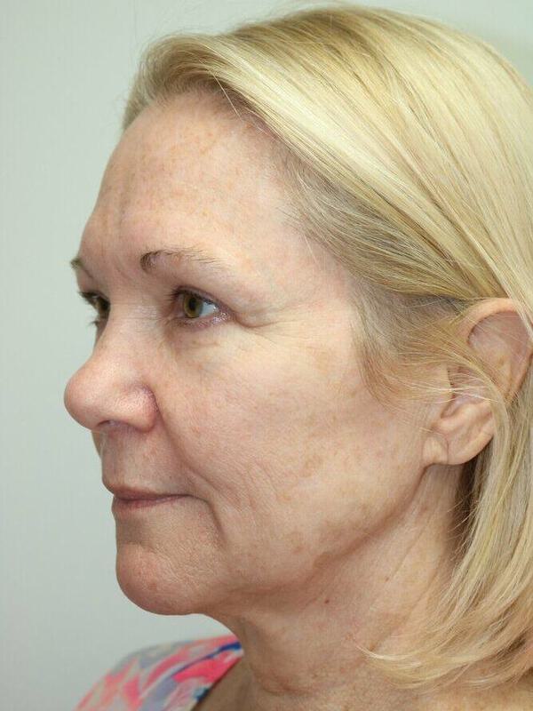 Facelift Before & After Image