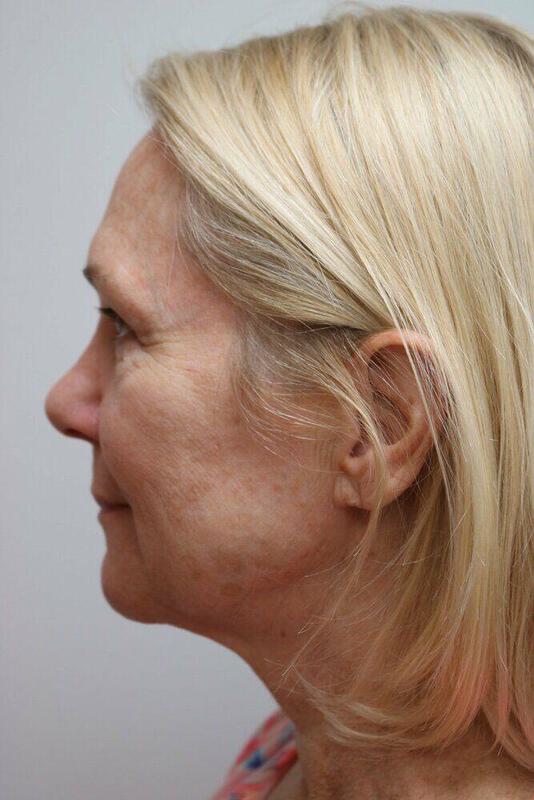 Facelift Before & After Image