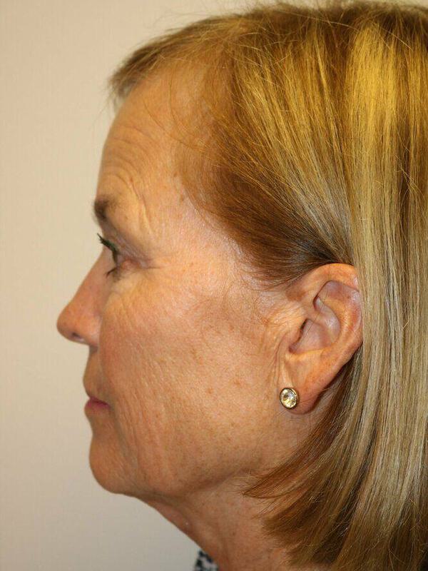 Facelift Before & After Image