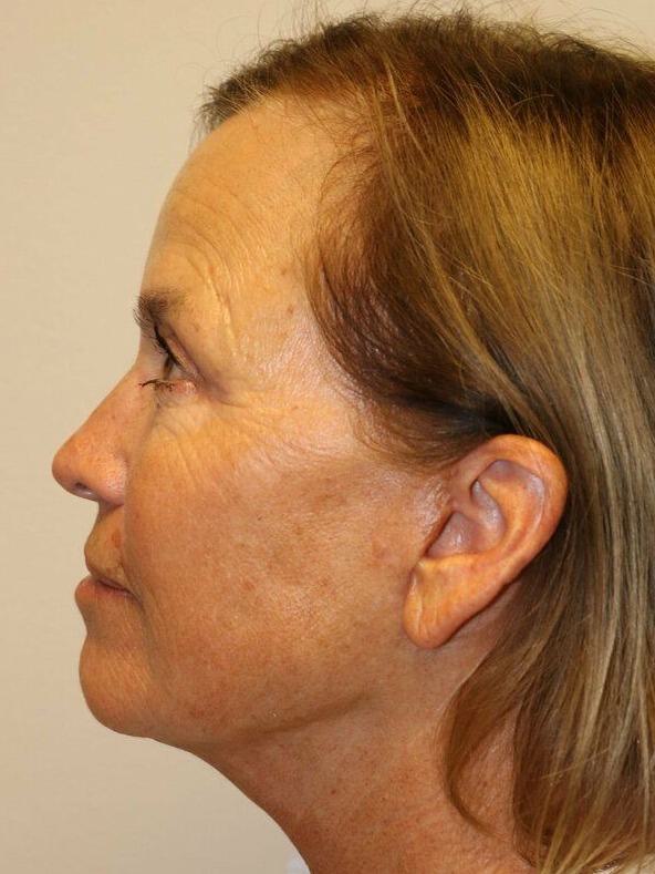 Facelift Before & After Image