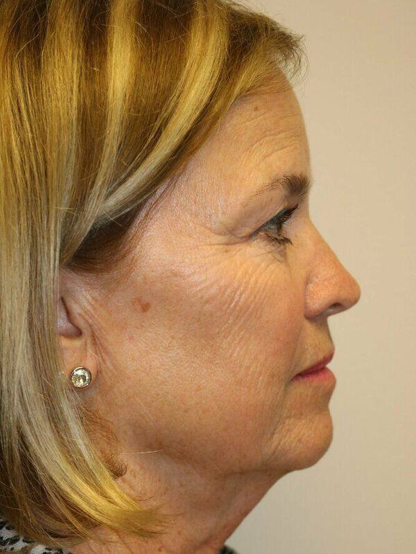 Facelift Before & After Image