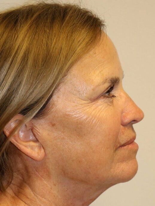 Facelift Before & After Image