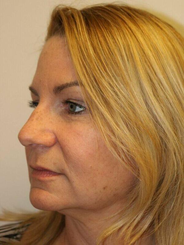 Facelift Before & After Image