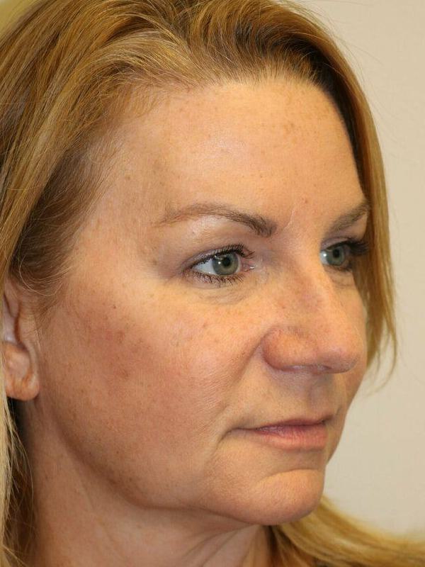 Facelift Before and After 04 | ARC Plastic Surgery