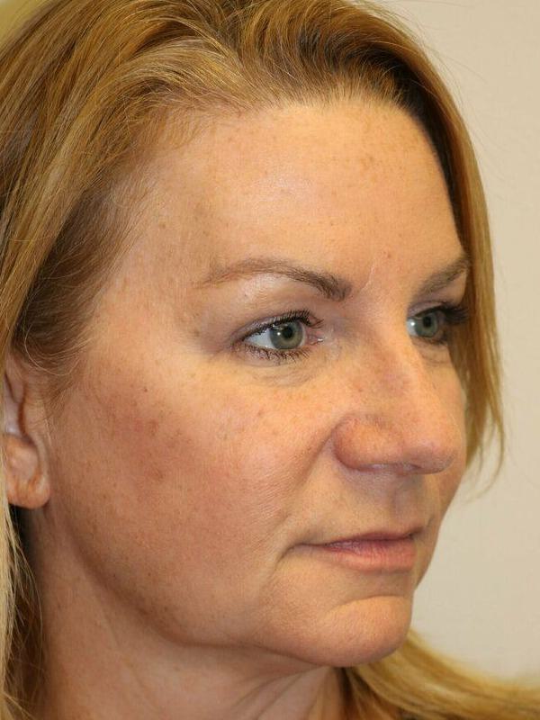 Facelift Before & After Image