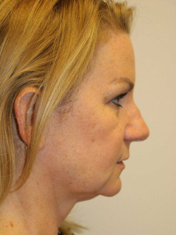 Facelift Before & After Image