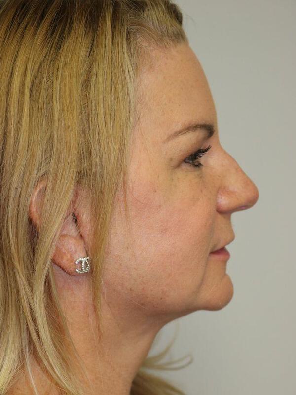 Facelift Before & After Image