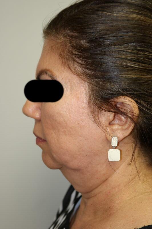 Facelift Before & After Image