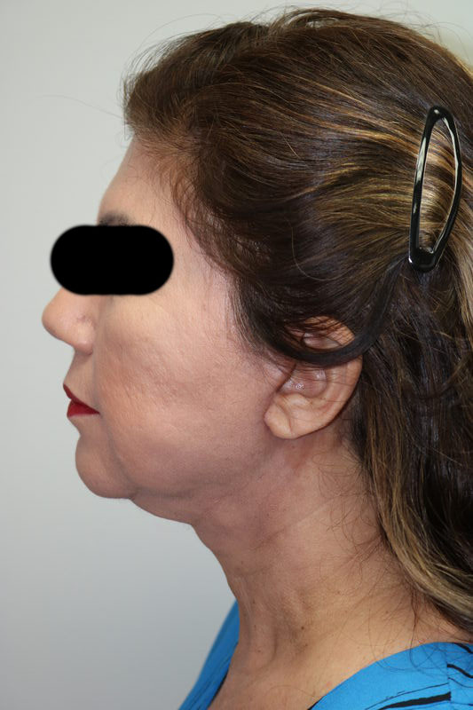 Facelift Before & After Image