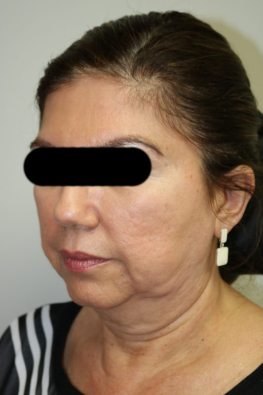 Facelift Before & After Image