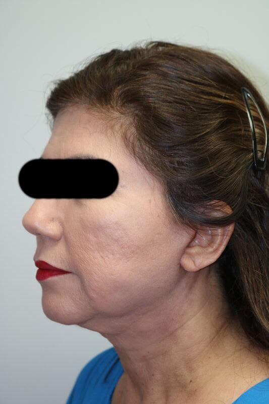 Facelift Before & After Image