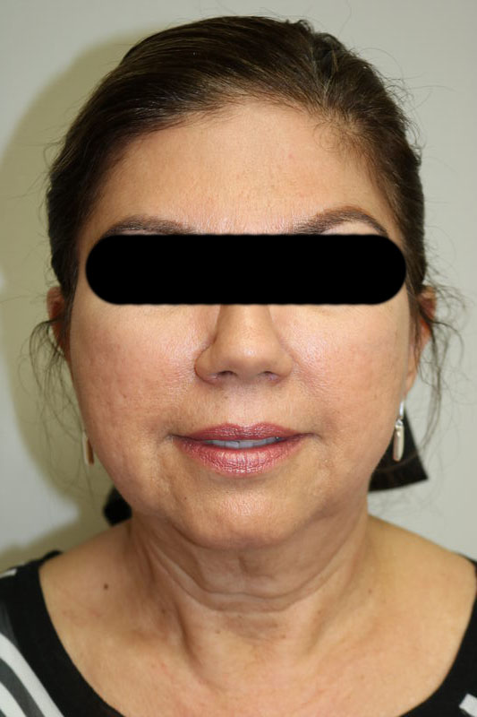 Facelift Before & After Image