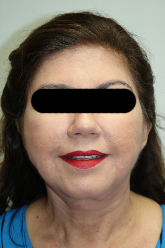 Facelift Before & After Image