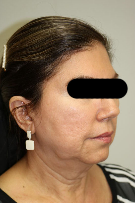 Facelift Before & After Image