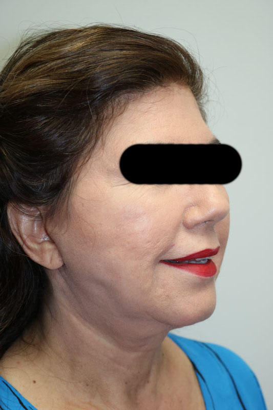 Facelift Before & After Image