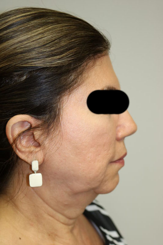 Facelift Before & After Image