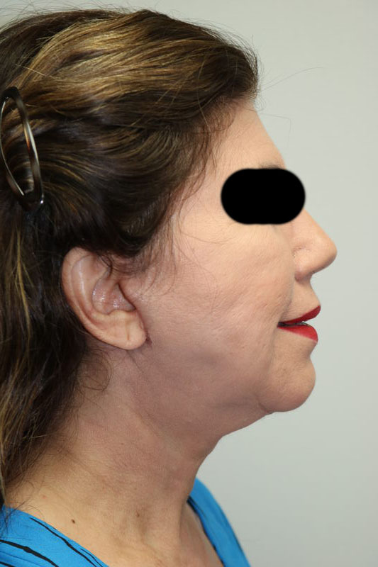 Facelift Before & After Image