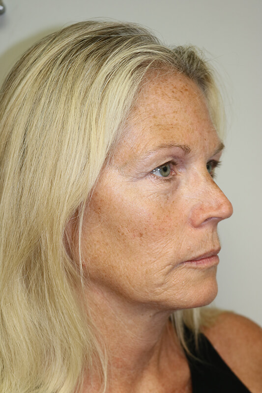 Facelift Before & After Image