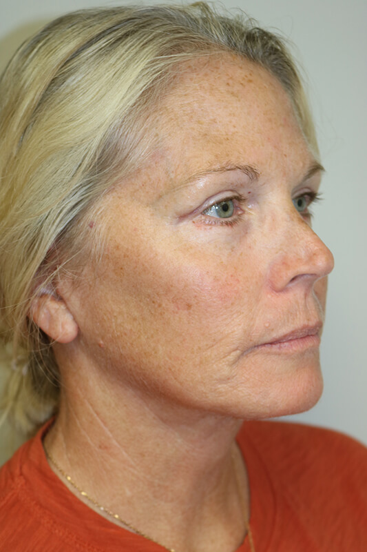 Facelift Before & After Image