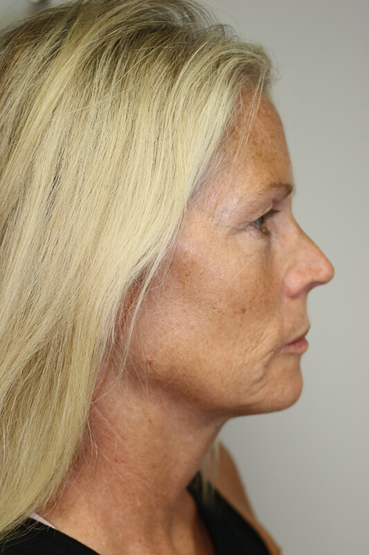 Facelift Before & After Image