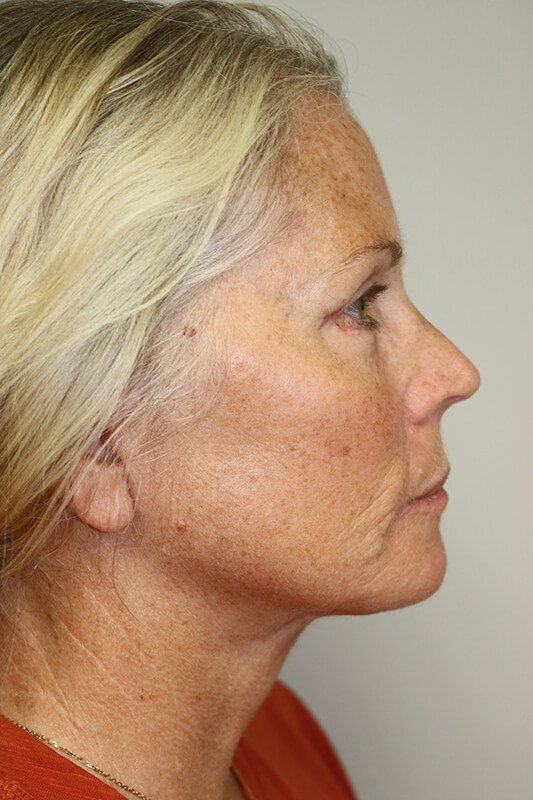 Facelift Before & After Image