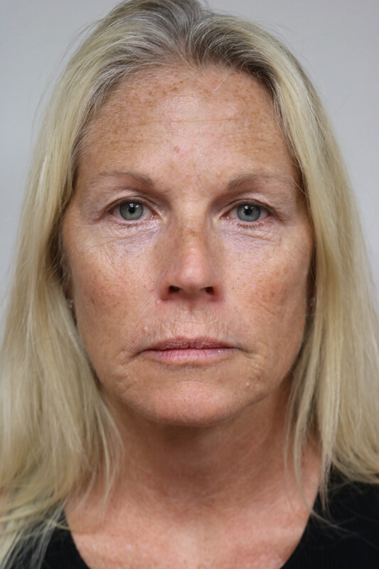 Facelift Before & After Image