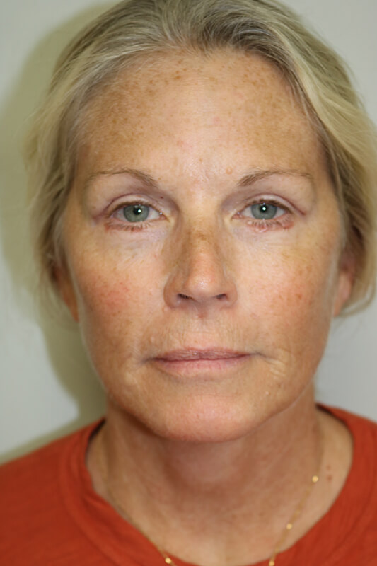 Facelift Before & After Image