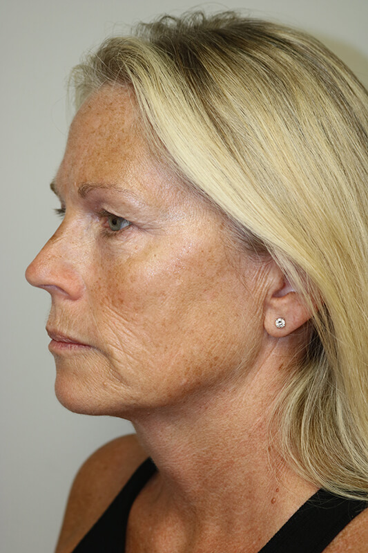 Facelift Before & After Image