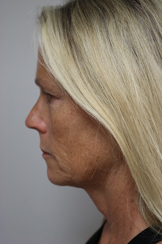 Facelift Before & After Image