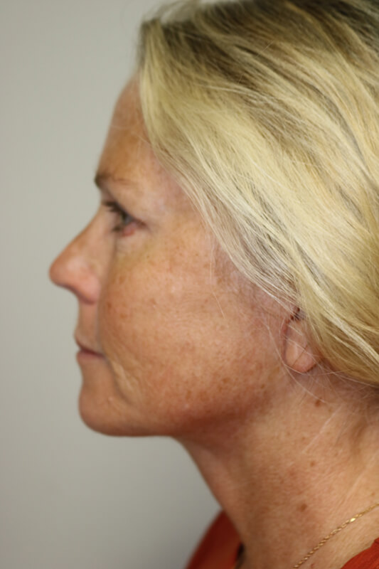 Facelift Before & After Image