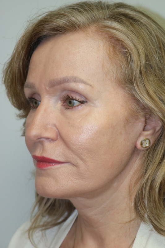 Facelift Before & After Image