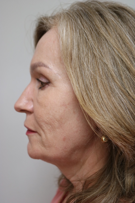 Facelift Before & After Image