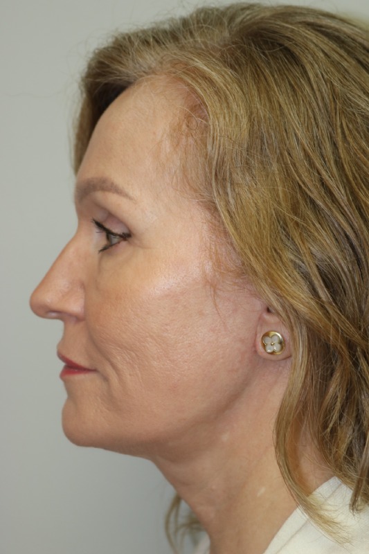 Facelift Before & After Image