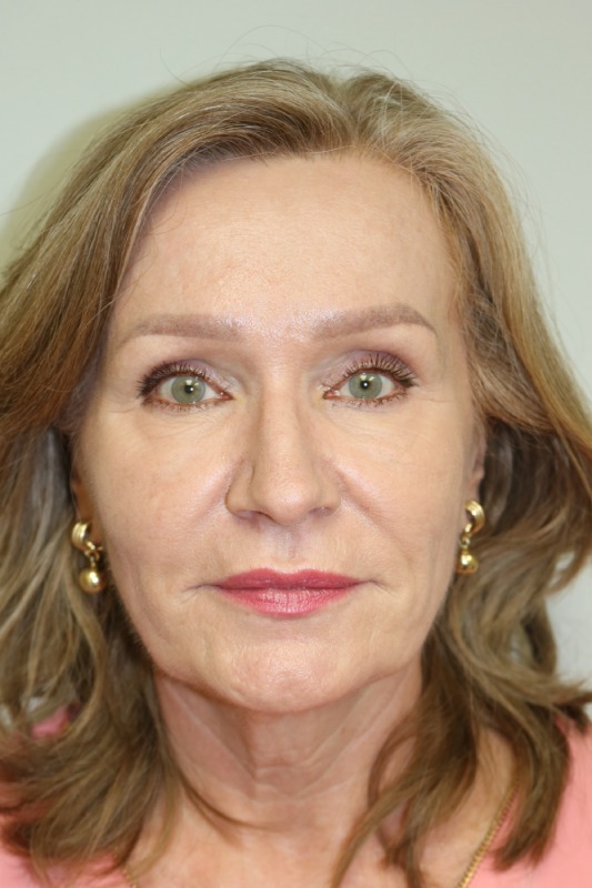 Facelift Before & After Image