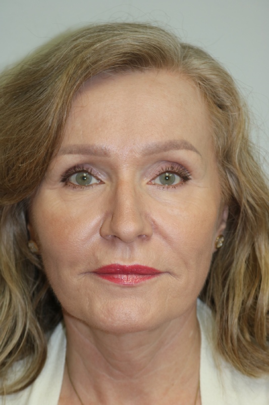 Facelift Before & After Image