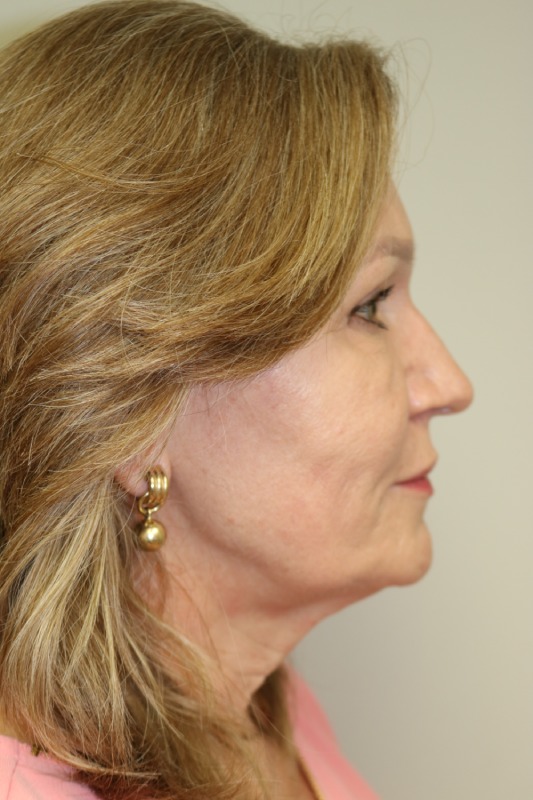 Facelift Before & After Image